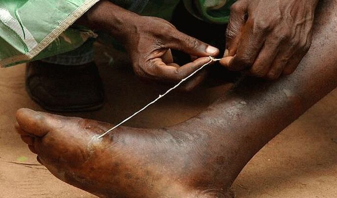 extraction of subcutaneous parasite from the foot