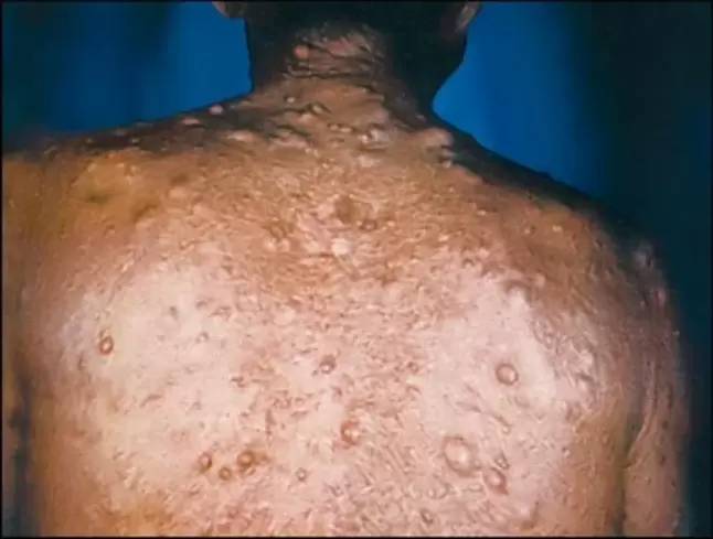 purulent nodes on the skin due to parasites